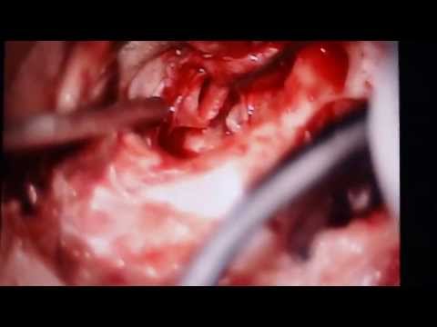 2 holes in the Ear Drum:How its repaired