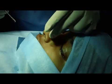 A Cute Nose in a Teenager – Rhinoplasty Concepts