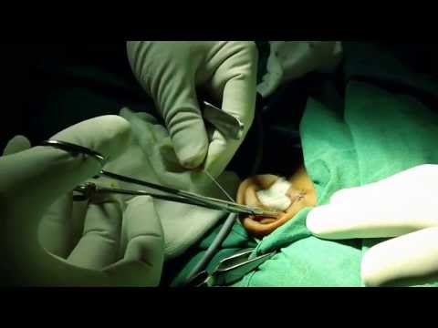 Accessory Auricle or Ear Tag