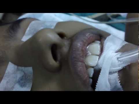 Adenoid Facies-Dentofacial Changes