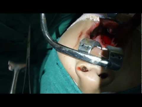 Adenoidectomy Cure Snoring and Sleep Apnea in Children
