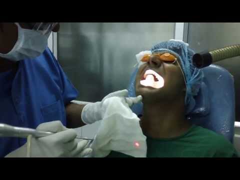 Adult Tongue Tie and Laser Surgery in India