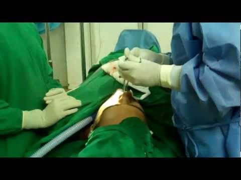 Affordable Cosmetic Nose Surgery in India