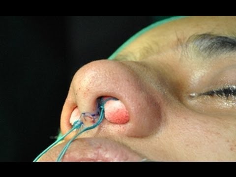 Affordable Cosmetic Rhinoplasty in South India