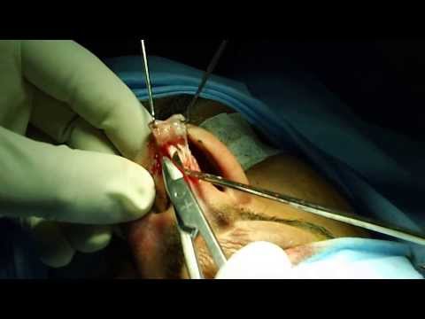 Affordable Rhinoplasty@Trivandrum Kerala South India