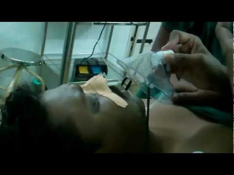 After Laser Surgery For Snoring and OSA-Post OP