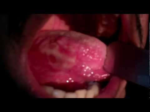 Agonising Painful Mouth Ulcers