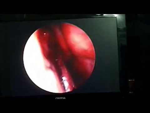 Allergic Nasal Polyps-Removal By Microdebrider