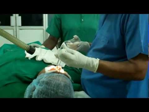 Allergic Nose Treated by Co2 Laser