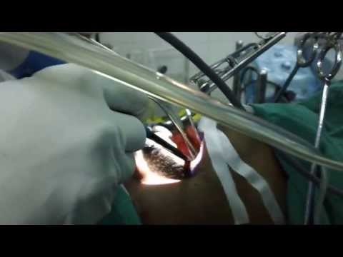 Alternative to CPAP Therapy ? About OSA Surgery