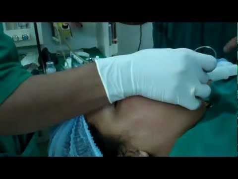 Anesthesia for Snoring Surgery in Obese Patient