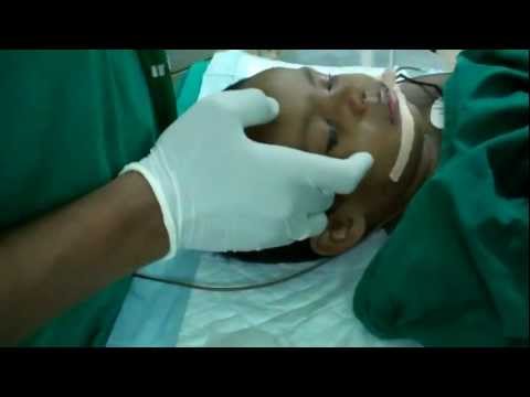Anesthesia in Children: Extubation
