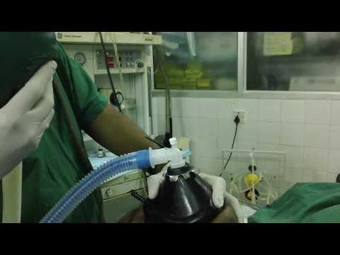 Anesthesia-Sleep Apnea Patient:Intubation