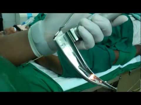 Anesthetic Considerations in Laser Surgery Throat:Dr.K.O.Paulose FRCS