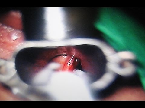 Anesthetic Issues in Microlaryngeal Surgery