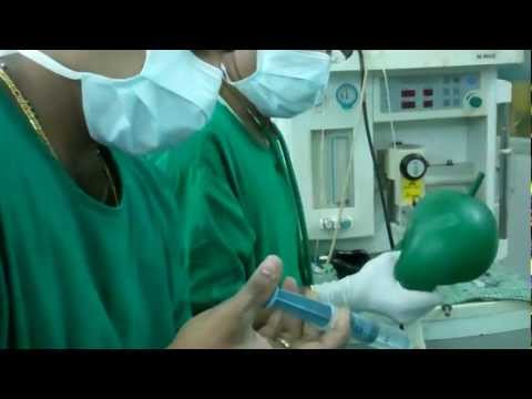 Anesthetising a patient for Laser Surgery for Snoring:Dr.K.O.PauloseFRCS