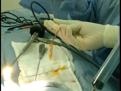 Anosmia (No sense of Smell) from Nasal Polyps and Sinusitis