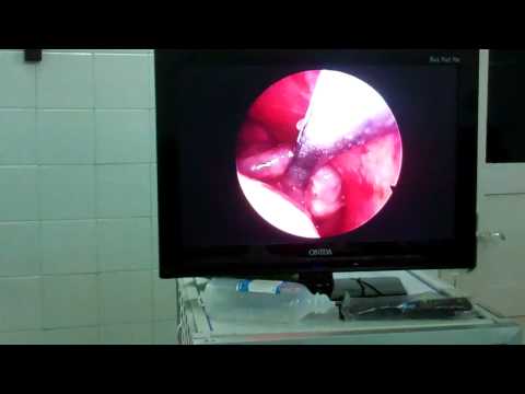 Antro Choanal Polyp Removed by Combined approach:Fess and Caldwel Luc
