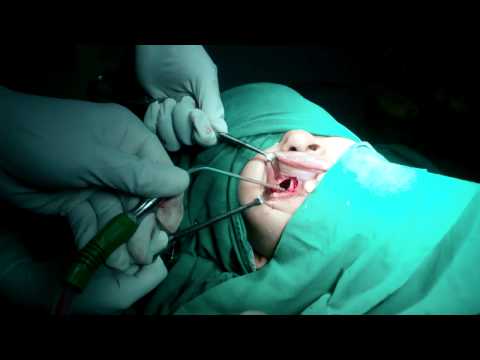 Antro Choanal Polyp:Surgical Treatment:Caldwel Luc and FESS