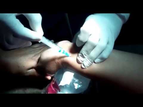 Arterial Blood Gas Test (ABG) in Sleep Apnea Patients