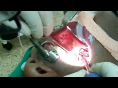 Bad Breath Due to Tonsil Stones:Treatment in Trivandrum India