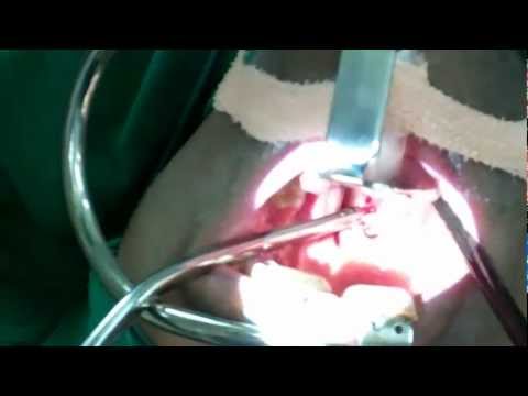 Bad Breath from Tonsil Stone: Surgical Treatment