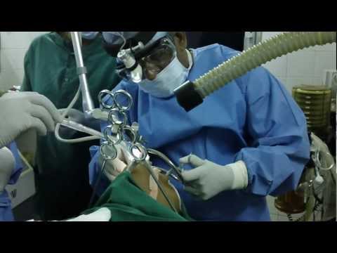 Bad Breath (Halitosis) Treated By Laser Surgery
