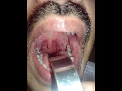 Bad Breath (Halitosis)-Treatment