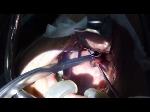 Bad Breath:Laser Tonsillectomy