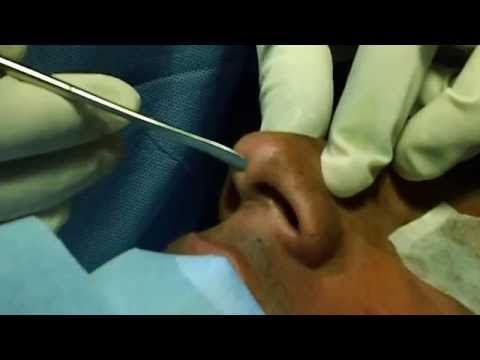 Before Nose Reshaping-Nose Job -Pre Op Evaluation