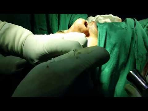 Breaking the bones in Rhinoplasty