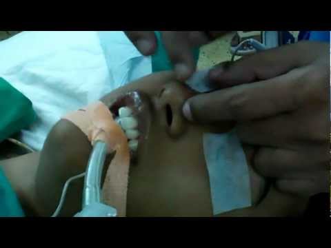 Bulbous Nasal Tip:Rhinoplasty in Trivandrum India