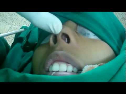 Can Septopasty be done in Children?