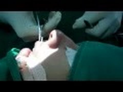 Can Septoplasty Correct a Crooked Nose?