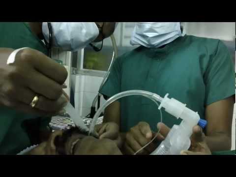 Cancer Larynx:Microlaryngeal Surgery in Trivandrum India
