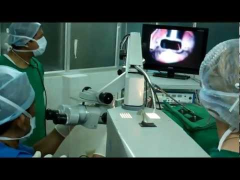 Cancer Larynx:Microlaryngoscopy and Biopsy
