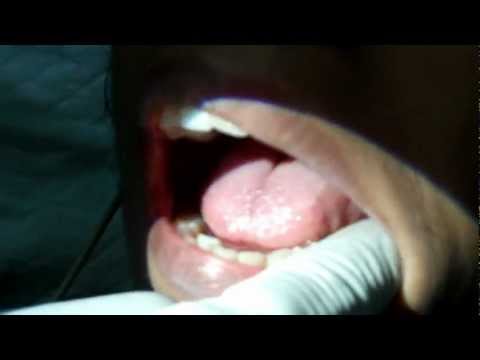 Cancer Tongue in Women: How to diagnosis?