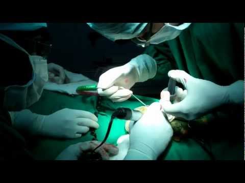 Chronic Ear Disease:Cholesteatoma Surgery in India