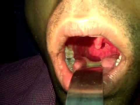 Chronic Sore Throat and Halitosis