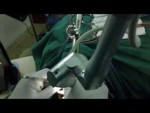 Chronic Sore Throat: Laser Surgery