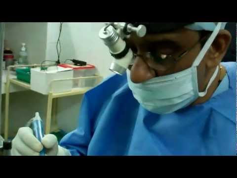 Coblator Surgery:Can It Cure Severe Snoring and Sleep Apnea