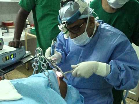 Coblator Surgery of Throat for Snoring and Sleep apnea