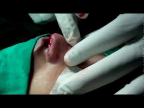 Cosmetic Augmentation Rhinoplasty in India