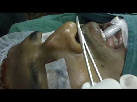 Cosmetic Nose Rhinoplasty India-Dorsal Hump