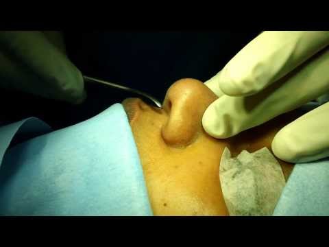 Cosmetic Nose Surgery in An Young Girl:Planning and Preparation