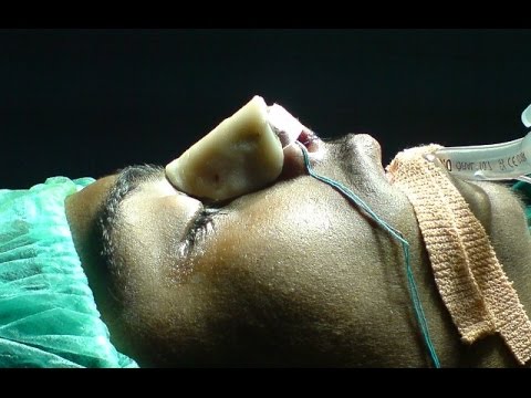 Cosmetic Nose Surgery-Trivandrum Kerala India