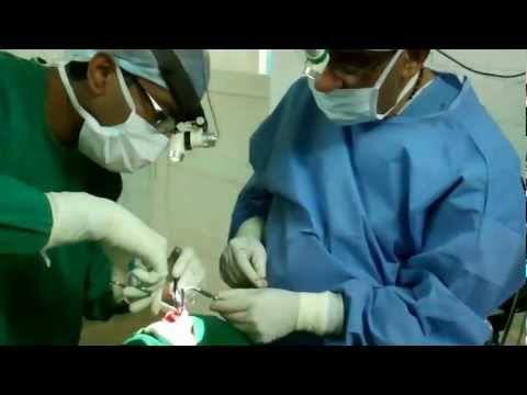 Cosmetic Rhinoplasty in India:Post Traumatic