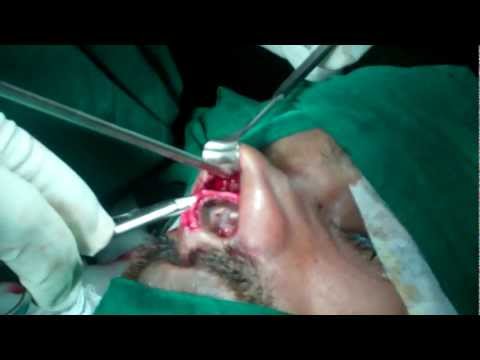 Cosmetic Rhinoplasty in Kerala,India