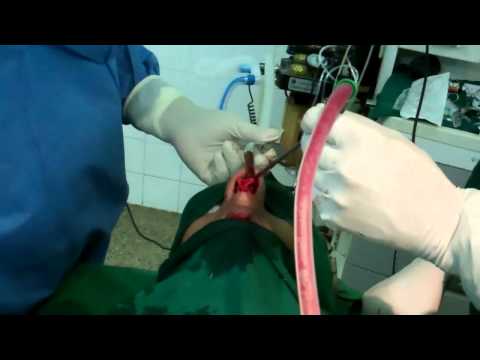 Cosmetic Rhinoplasty in Trivandrum, India