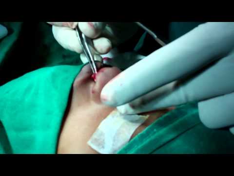 Cosmetic Rhinoplasty:Sculpturing cartilage grafts